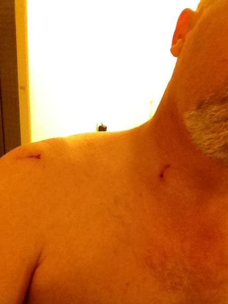 skullduggery-albums-damage++her+%28during+testing..%29-picture9065-nick-neck-sholder-there-no-less-then-5-spots-my-neck-larger-one-sholder.jpg