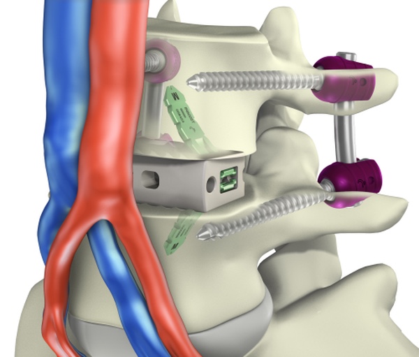Lumbar Disc Surgery-hardware-jpg