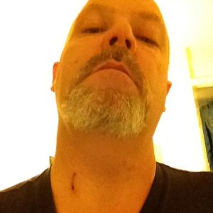 On the cheek a little nick and all over the neck. Two on the top of my head as well...