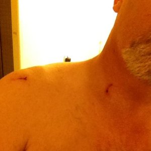 Nick on the neck and sholder. There are no less then 5 spots on my neck and a larger one on the sholder.