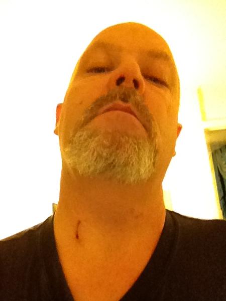 On the cheek a little nick and all over the neck. Two on the top of my head as well...